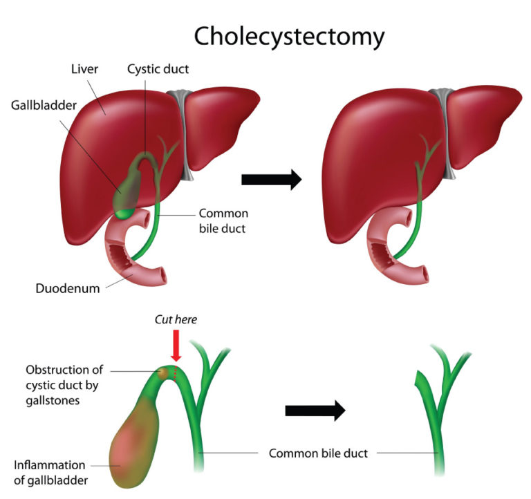 Gallbladder Surgery | Bile Ducts Surgery | Weightloss Operations