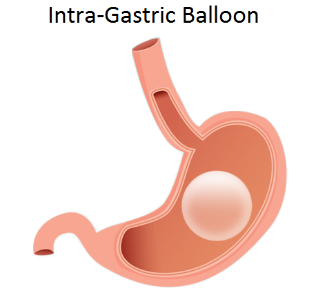 Masaccio Sluier Ritueel Orbera Gastric Balloon | Non Surgical | General Surgery Gold Coast