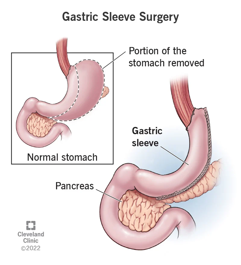 Sleeve Gastrectomy Surgery Explained