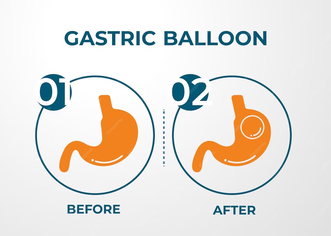 Not ready for surgery? The intra-gastric balloon could be your next step