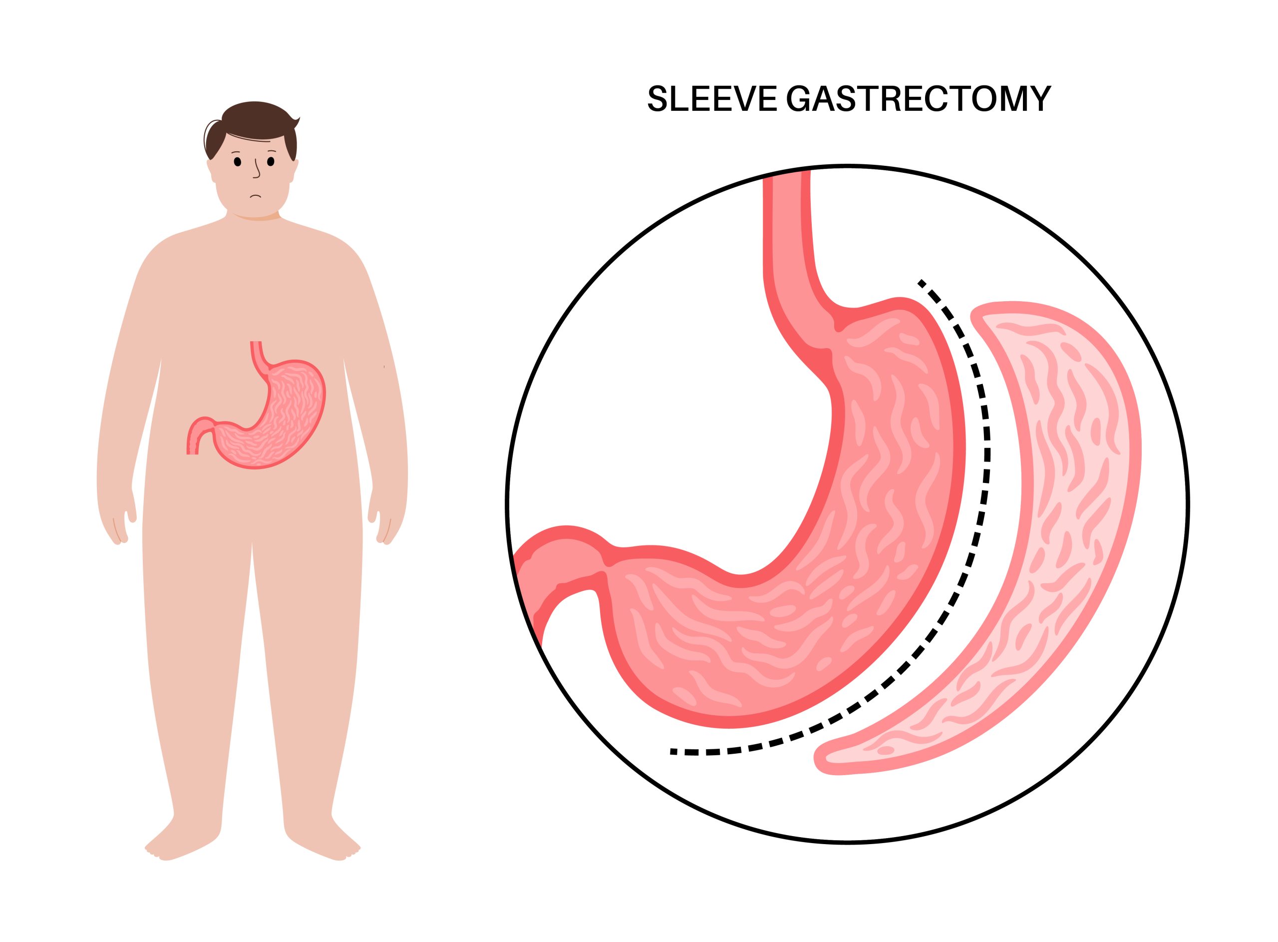 Top Benefits of Sleeve Gastrectomy for Long-Term Weight Loss